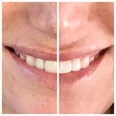 Phenomenal teeth whitening!