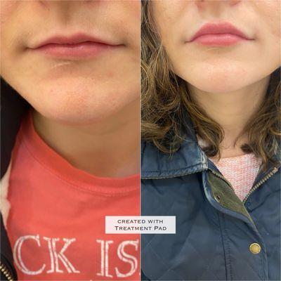 "Small lips to naturally balanced lips -- a subtle transformation that speaks for itself "