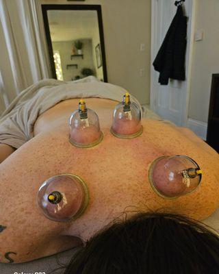 Cupping therapy