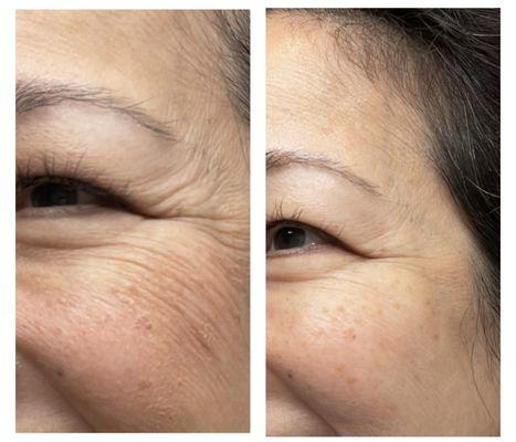Before and after using Nourish+Repair Cream (7 days after).
