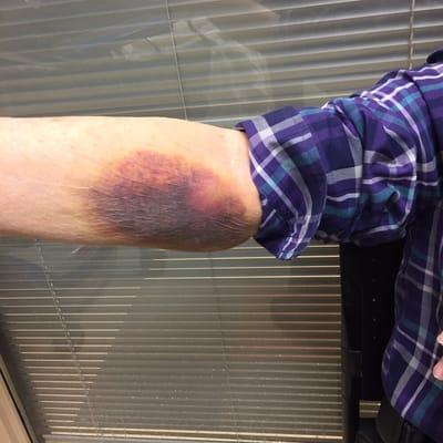 The hematoma caused by the poor bloodwork