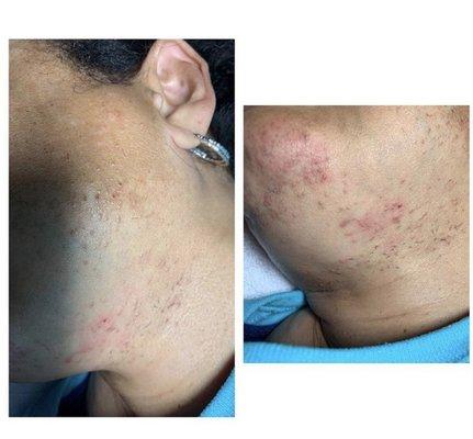 Simply Flawless Electrolysis