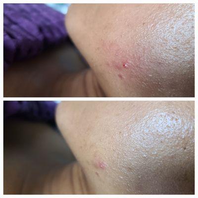 Before high frequency therapy on the top. After high frequency on the bottom.