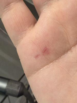 The wound on my hand three days after the piercing fiasco.