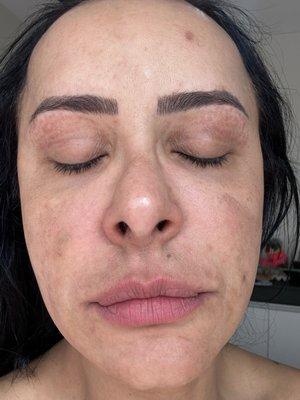My face when I saw Tatiana for the first time. I had melasma specifically on my eyelids very bad.