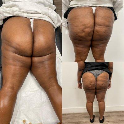 Endomology and wood therapy is it hun I love my results