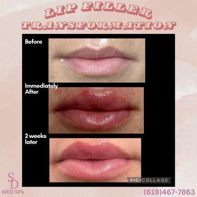 1 syringe of filler on this new patient gave her the lips of her dreams!