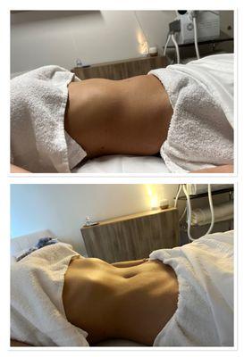 Brazilian Body Sculpting