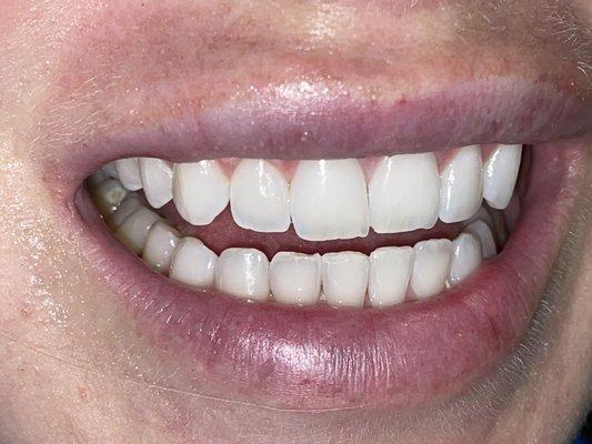 After my cleaning and whitening service at Beverly Hills Dental.