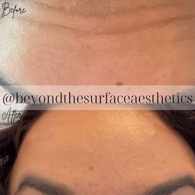 Botox for forehead wrinkles