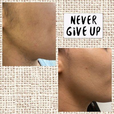 Before and after 2 laser treatments.