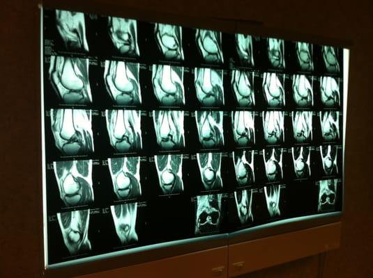 Yep, my ACL was torn in two.