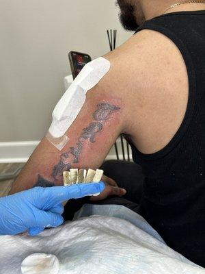 Tattoo Remove 88