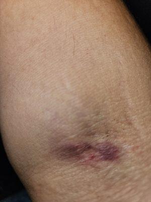 A terrible needle job.