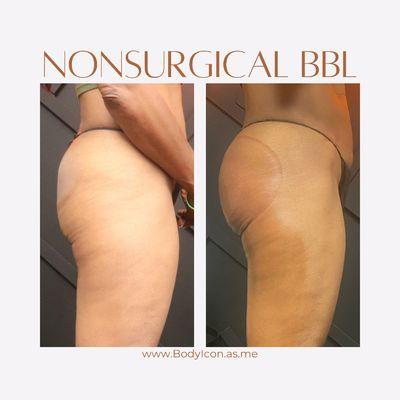 One session noninvasive BBL
