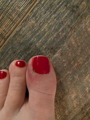 Infected toe