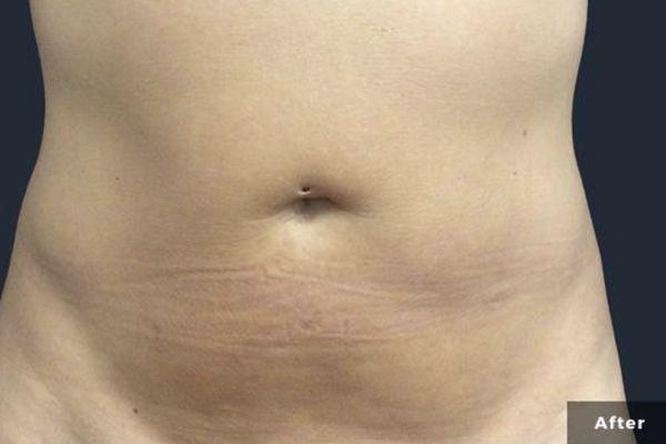 180° before and after