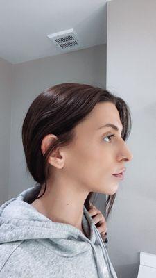 Side profile of the beautiful lips with filler & Botox in the chin.