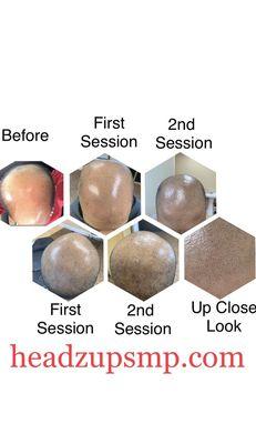 "I'm enjoying my first morning with a hairline in 10 years" Rich