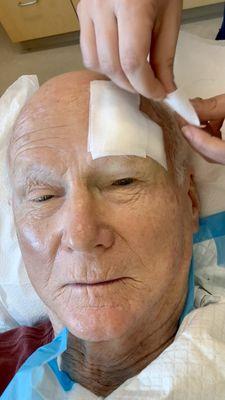 You can hardly see the scar on my chin from last year. On my forehead, Dr. Goldbach was careful to stretch my skin from the sides, not up.