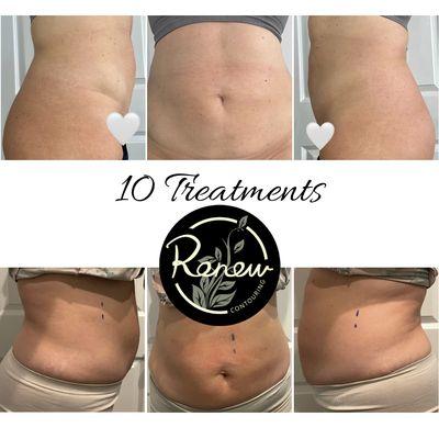 This client had lumps and bumps from liposuction. We smoothed her out in just 10 treatments.