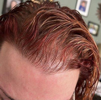 Second scalp treatment