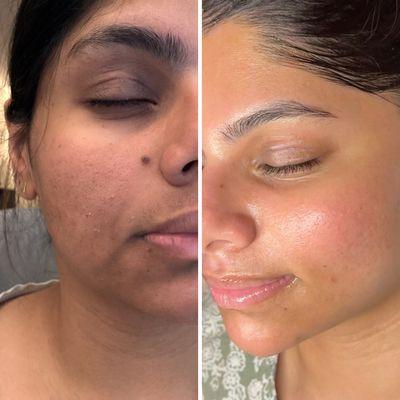 3 month progress with consistent monthly treatments and home care
