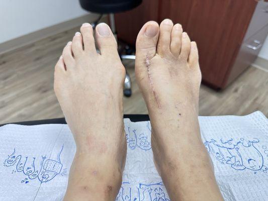 Bunion surgery on right foot. Still in recovery mode.