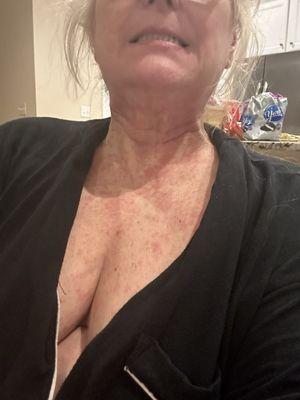 Rash associated with post surgery