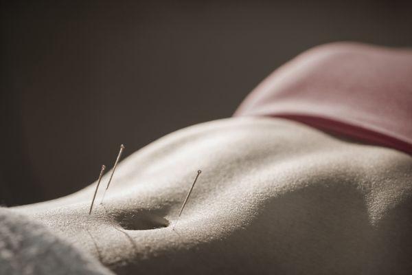 Acupuncture needles are as small as a strand of hair, and go in smoothly and nearly painlessly.