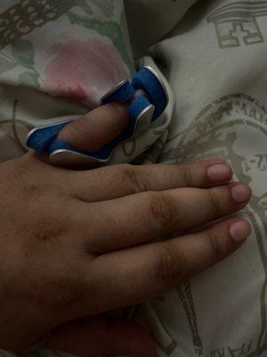 6 weeks later with doctors office neglect still with a Broken finger they didn't fix my bone yet