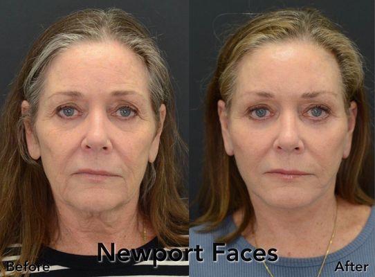 Newport Faces Cosmetic Surgery