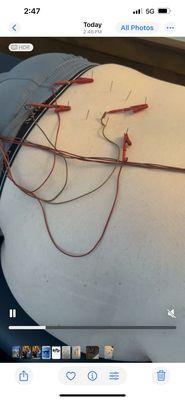 Brambert Chiropractic And Acupuncture