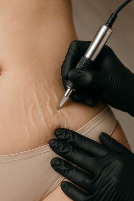 Paramedical tattooing/ strech marks revision!