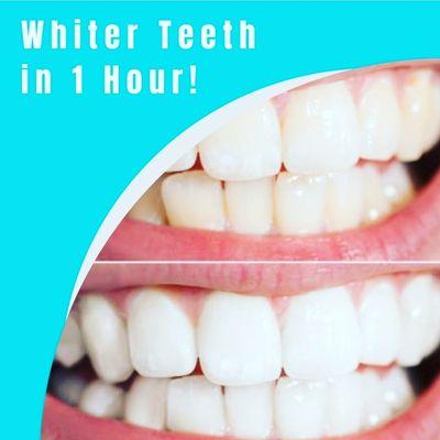 Teeth whitening