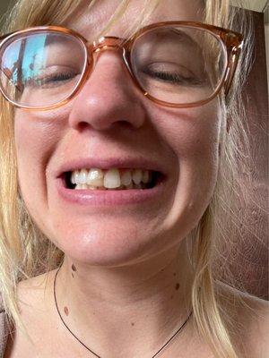 My little broken tooth