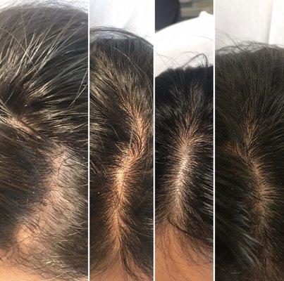 Hair restoration with PRP!!