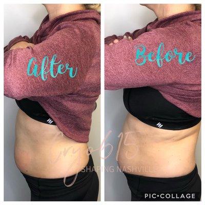 Before and after 1 slimming.