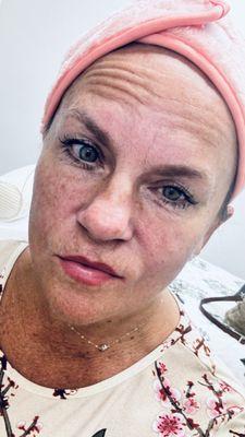 Before a nano needle