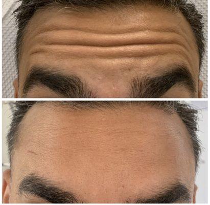 Before and after forehead lines