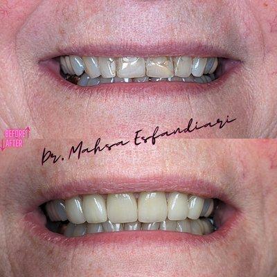 Age-Defying Smile Makeover at 72: Emax Veneers Transformation by Dr. Mahsa Esfandiari