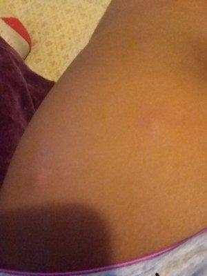 What are these bumps
