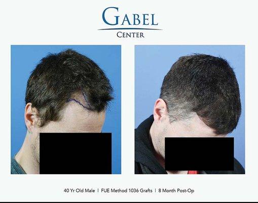 Dr. Gabel performed the follicular unit excision transplant in one session, using 1036 hair grafts to fill in the area. FUE