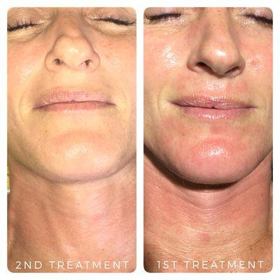 Microneedling Treatment