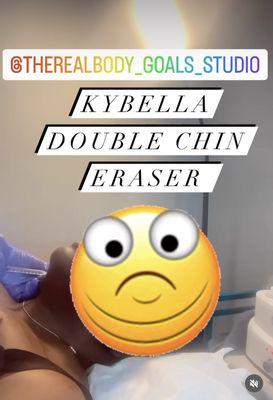Kybella Double Chin Eraser