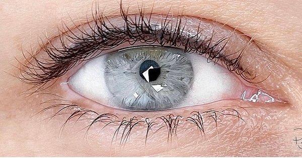 After Upper Eyeliner Procedure