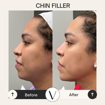 Chin filler