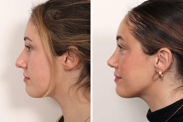 7 months after open rhinoplasty by Dr. Benjamin Paul