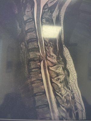 Cervical spine at the start of treatment, 9.2mm disc bulge pressing into the spine.