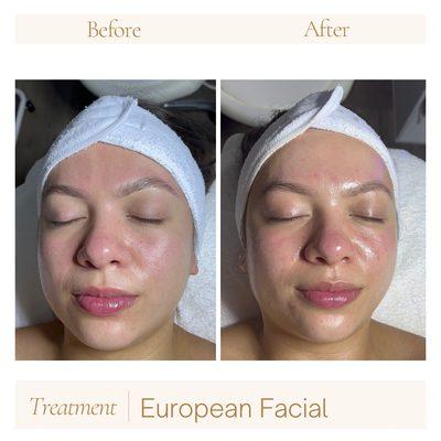 Before and after facial skin looks glowing